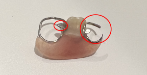 保険の入れ歯写真｜【症例】 保険適応の入れ歯をノンクラスプデンチャーに作り替え｜センター南デンタルクリニック