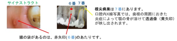 サイナストラクト（フィステル）の写真｜サイナストラクト（フィステル）とは？症例写真で見る診断と治療｜センター南の歯医者「センター南デンタルクリニック」