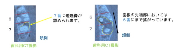 歯科用CTで撮影した写真｜サイナストラクト（フィステル）とは？症例写真で見る診断と治療｜センター南の歯医者「センター南デンタルクリニック」