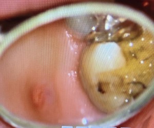 根尖病巣の写真｜サイナストラクト（フィステル）とは？症例写真で見る診断と治療｜センター南の歯医者「センター南デンタルクリニック」