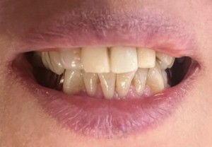 治療前の写真｜【症例】前歯の被せ物をセラミックにやりかえた治療｜センター南の歯医者「センター南デンタルクリニック」