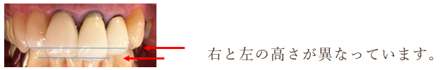 治療前の画像｜【症例】前歯の被せ物をセラミックにやりかえた治療｜センター南の歯医者「センター南デンタルクリニック」