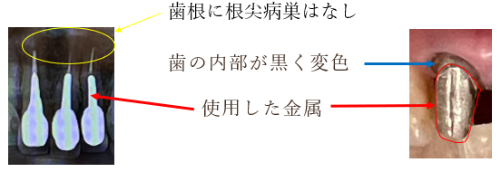 パノラマX線写真と実際の歯の写真｜【症例】前歯の被せ物をセラミックにやりかえた治療｜センター南の歯医者「センター南デンタルクリニック」