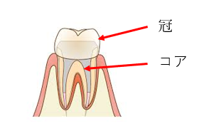 差し歯の解説画像｜【症例】前歯の被せ物をセラミックにやりかえた治療｜センター南の歯医者「センター南デンタルクリニック」