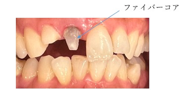 ファイバーコア｜【症例】前歯の審美的な改善を目的とした治療｜センター南の歯医者「センター南デンタルクリニック」