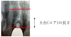 コアの長さがわかるX線画像｜【症例】前歯の審美的な改善を目的とした治療｜センター南の歯医者「センター南デンタルクリニック」
