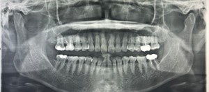 歯の穿孔とは？MTAセメントによる歯の保存治療を症例で解説｜センター南の歯医者「センター南デンタルクリニック」