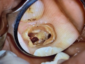 歯の穿孔とは？MTAセメントによる歯の保存治療を症例で解説｜センター南の歯医者「センター南デンタルクリニック」