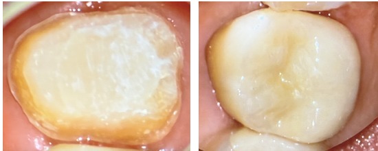 歯の穿孔とは？MTAセメントによる歯の保存治療を症例で解説｜センター南の歯医者「センター南デンタルクリニック」