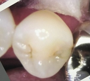 治療前の写真｜【症例】銀歯を白いセラミックに変えた修復治療｜センター南の歯医者「センター南デンタルクリニック」
