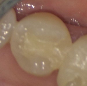 治療後の写真｜【症例】銀歯を白いセラミックに変えた修復治療｜センター南の歯医者「センター南デンタルクリニック」