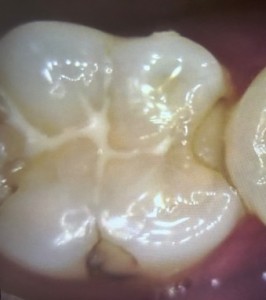 治療前の写真｜プラスチックの詰め物から虫歯が再発した歯の修復治療｜センター南の歯医者「センター南デンタルクリニック」