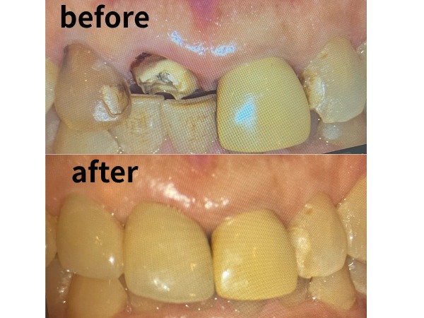 ビフォアーアフター画像|【症例】差し歯が外れてジルコニアセラミックで修復した前歯|センター南の歯医者「センター南デンタルクリニック」