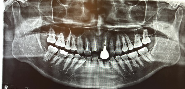 治療前のパノラマ写真｜【症例】差し歯が外れてジルコニアセラミックで修復した前歯｜センター南の歯医者「センター南デンタルクリニック」