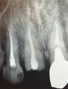 治療前のデンタル写真｜【症例】差し歯が外れてジルコニアセラミックで修復した前歯｜センター南の歯医者「センター南デンタルクリニック」