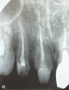 治療後のデンタル写真｜【症例】差し歯が外れてジルコニアセラミックで修復した前歯｜センター南の歯医者「センター南デンタルクリニック」