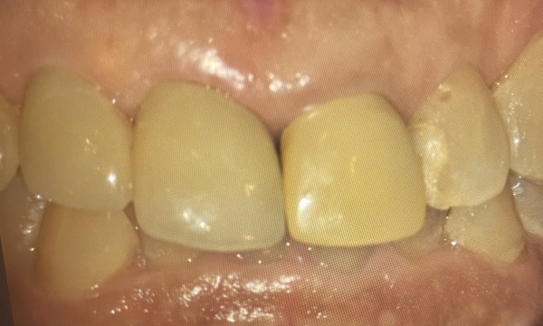 治療後の写真｜【症例】差し歯が外れてジルコニアセラミックで修復した前歯｜センター南の歯医者「センター南デンタルクリニック」