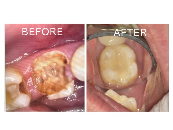 ビフォアーアフター画像｜左下の虫歯治療をきっかけに、日本で通える歯科医院を探していた患者様のセラミック修復治療｜センター南の歯医者「センター南デンタルクリニック」