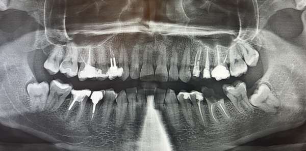 治療前のパノラマ画像｜【症例】左下の大きな虫歯をセラミックで修復した治療｜センター南の歯医者「センター南デンタルクリニック」