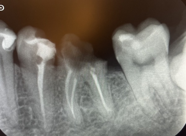 治療前のデンタル画像｜【症例】左下の大きな虫歯をセラミックで修復した治療｜センター南の歯医者「センター南デンタルクリニック」