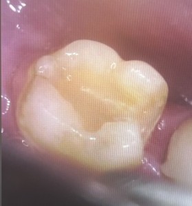 型取り前の写真｜【症例】左下の大きな虫歯をセラミックで修復した治療｜センター南の歯医者「センター南デンタルクリニック」