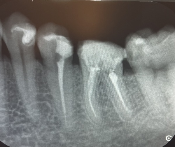 治療後のデンタル画像｜【症例】左下の大きな虫歯をセラミックで修復した治療｜センター南の歯医者「センター南デンタルクリニック」