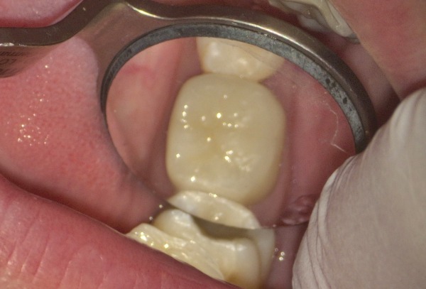 治療後の写真｜【症例】左下の大きな虫歯をセラミックで修復した治療｜センター南の歯医者「センター南デンタルクリニック」