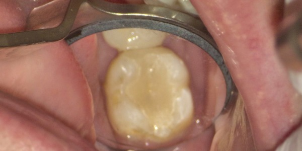 治療後の写真｜【症例】左下の大きな虫歯をセラミックで修復した治療｜センター南の歯医者「センター南デンタルクリニック」