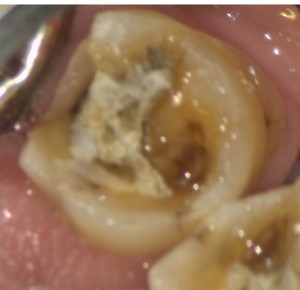 治療前の写真｜【症例】強度に優れたジルコニア修復治療と歯周病治療｜センター南の歯医者「センター南デンタルクリニック」