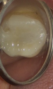 治療後の写真｜【症例】強度に優れたジルコニア修復治療と歯周病治療｜センター南の歯医者「センター南デンタルクリニック」