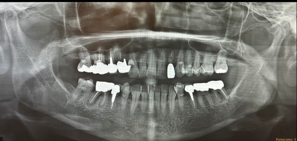 パノラマ写真｜【症例】強度に優れたジルコニア修復治療と歯周病治療｜センター南の歯医者「センター南デンタルクリニック」