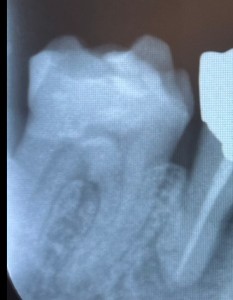 デンタル写真｜【症例】強度に優れたジルコニア修復治療と歯周病治療｜センター南の歯医者「センター南デンタルクリニック」