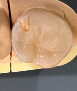 模型の写真｜【症例】強度に優れたジルコニア修復治療と歯周病治療｜センター南の歯医者「センター南デンタルクリニック」