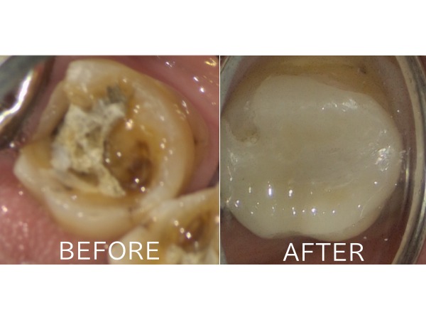 ビフォアーアフター画像｜【症例】強度に優れたジルコニア修復治療と歯周病治療｜センター南の歯医者「センター南デンタルクリニック」