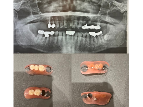 ビフォアーアフター画像|【症例】ブリッジが適用できなくなった奥歯の咬合を補うノンクラスプデンチャー|センター南の歯医者「センター南デンタルクリニック」