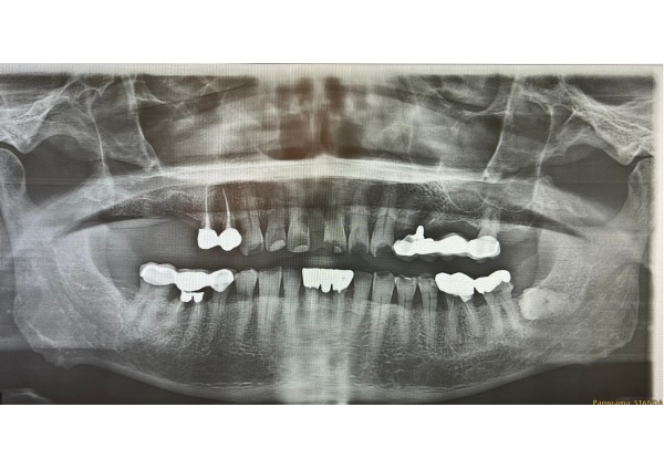 パノラマ写真|【症例】ブリッジが適用できなくなった奥歯の咬合を補うノンクラスプデンチャー|センター南の歯医者「センター南デンタルクリニック」