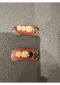 義歯の写真|【症例】ブリッジが適用できなくなった奥歯の咬合を補うノンクラスプデンチャー|センター南の歯医者「センター南デンタルクリニック」