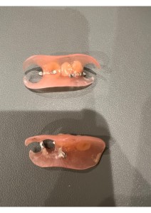 義歯背面の写真|【症例】ブリッジが適用できなくなった奥歯の咬合を補うノンクラスプデンチャー|センター南の歯医者「センター南デンタルクリニック」