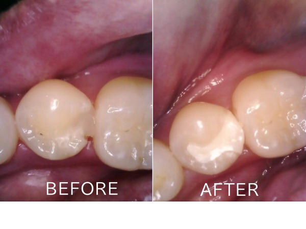 ビフォアーアフター画像｜【症例】 欠けたプラスチックを強度のあるジルコニアに変更した治療｜センター南の歯医者「センター南デンタルクリニック」