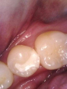 治療後の画像｜【症例】 欠けたプラスチックを強度のあるジルコニアに変更した治療｜センター南の歯医者「センター南デンタルクリニック」