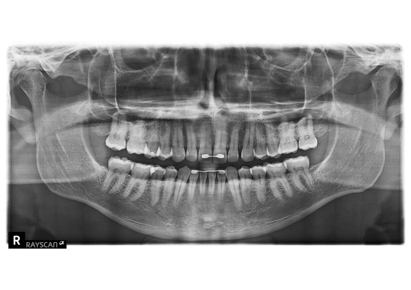 パノラマ画像｜【症例】 欠けたプラスチックを強度のあるジルコニアに変更した治療｜センター南の歯医者「センター南デンタルクリニック」