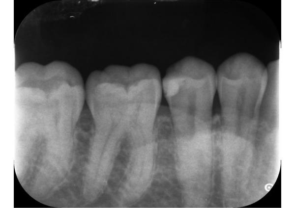 デンタル画像｜【症例】 欠けたプラスチックを強度のあるジルコニアに変更した治療｜センター南の歯医者「センター南デンタルクリニック」