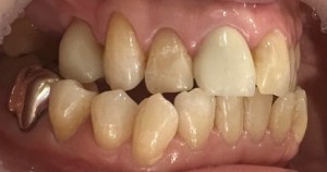 治療後|【症例】抜歯してから時間が経過し、被せ物と義歯で修 復した治療|センター南の歯医者「センター南デンタルクリニック」