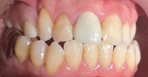 治療後②|【症例】抜歯してから時間が経過し、被せ物と義歯で修 復した治療|センター南の歯医者「センター南デンタルクリニック」