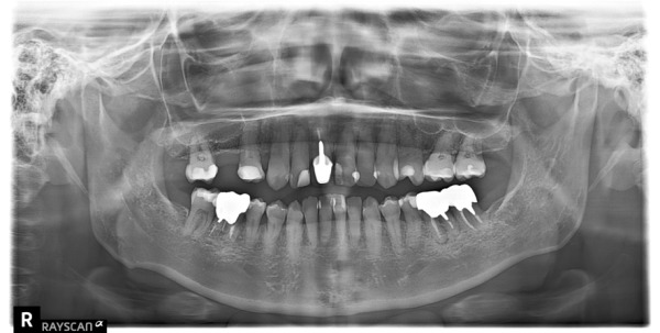 パノラマ図|【症例】抜歯してから時間が経過し、被せ物と義歯で修 復した治療|センター南の歯医者「センター南デンタルクリニック」