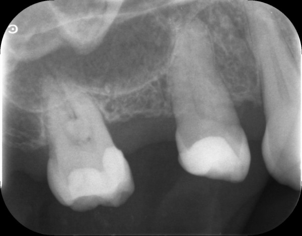 デンタル図|【症例】抜歯してから時間が経過し、被せ物と義歯で修 復した治療|センター南の歯医者「センター南デンタルクリニック」