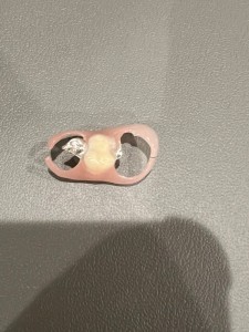 義歯の表|【症例】抜歯してから時間が経過し、被せ物と義歯で修 復した治療|センター南の歯医者「センター南デンタルクリニック」