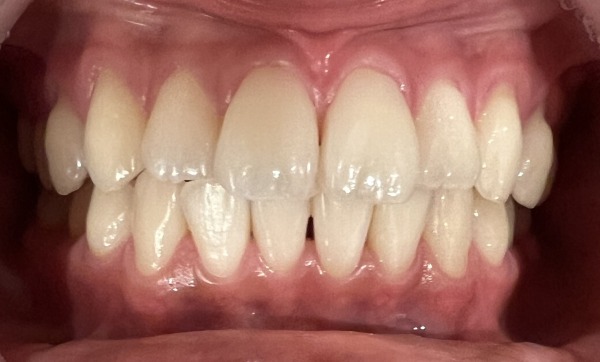 治療前｜【症例】約2週間のホームホワイトニングにより歯を白くした治療｜センター南の歯医者「センター南デンタルクリニック」