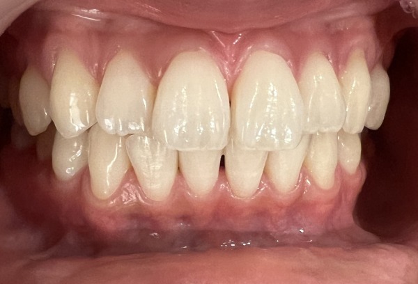 治療後｜【症例】約2週間のホームホワイトニングにより歯を白くした治療｜センター南の歯医者「センター南デンタルクリニック」