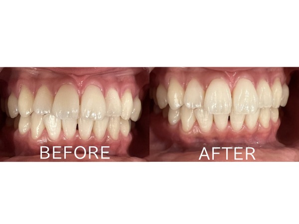ビフォアーアフター画像｜【症例】約2週間のホームホワイトニングにより歯を白くした治療｜センター南の歯医者「センター南デンタルクリニック」